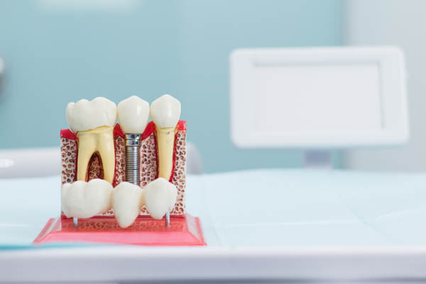 What Foods Are Friendly To Dental Implants?