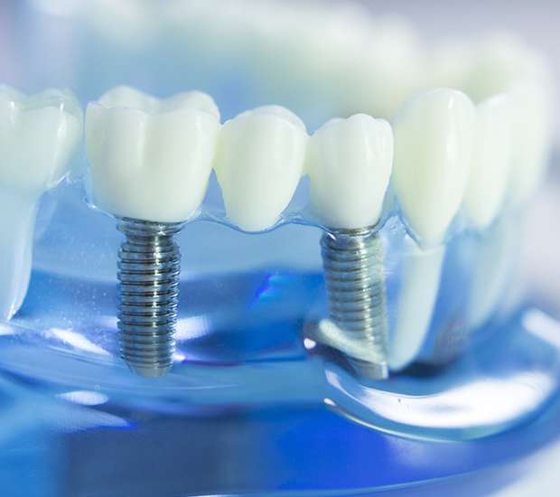 Chapel Hill Dental Implants