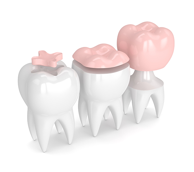 Chapel Hill Dental Inlays and Onlays